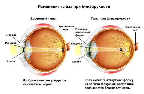 Изменение рефракции глаза при близорукости
