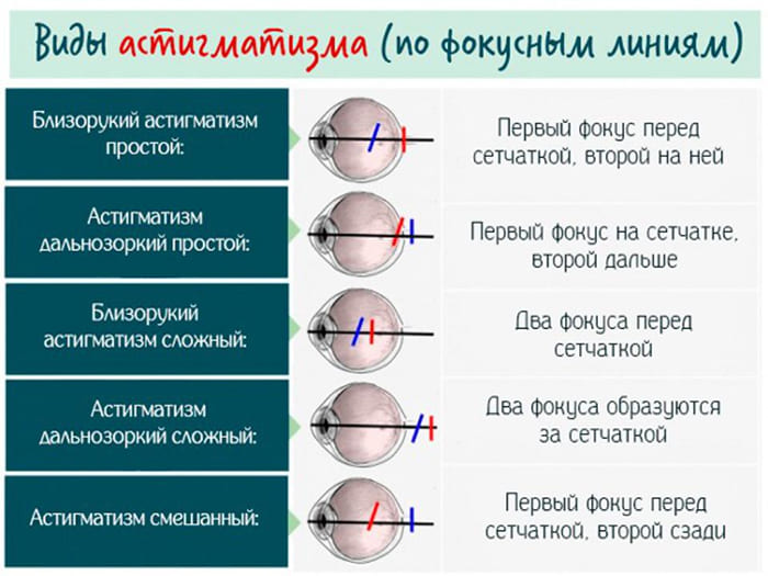 Разновидности астигматизма в зависимости от положения фокусов по отношению к сетчатке